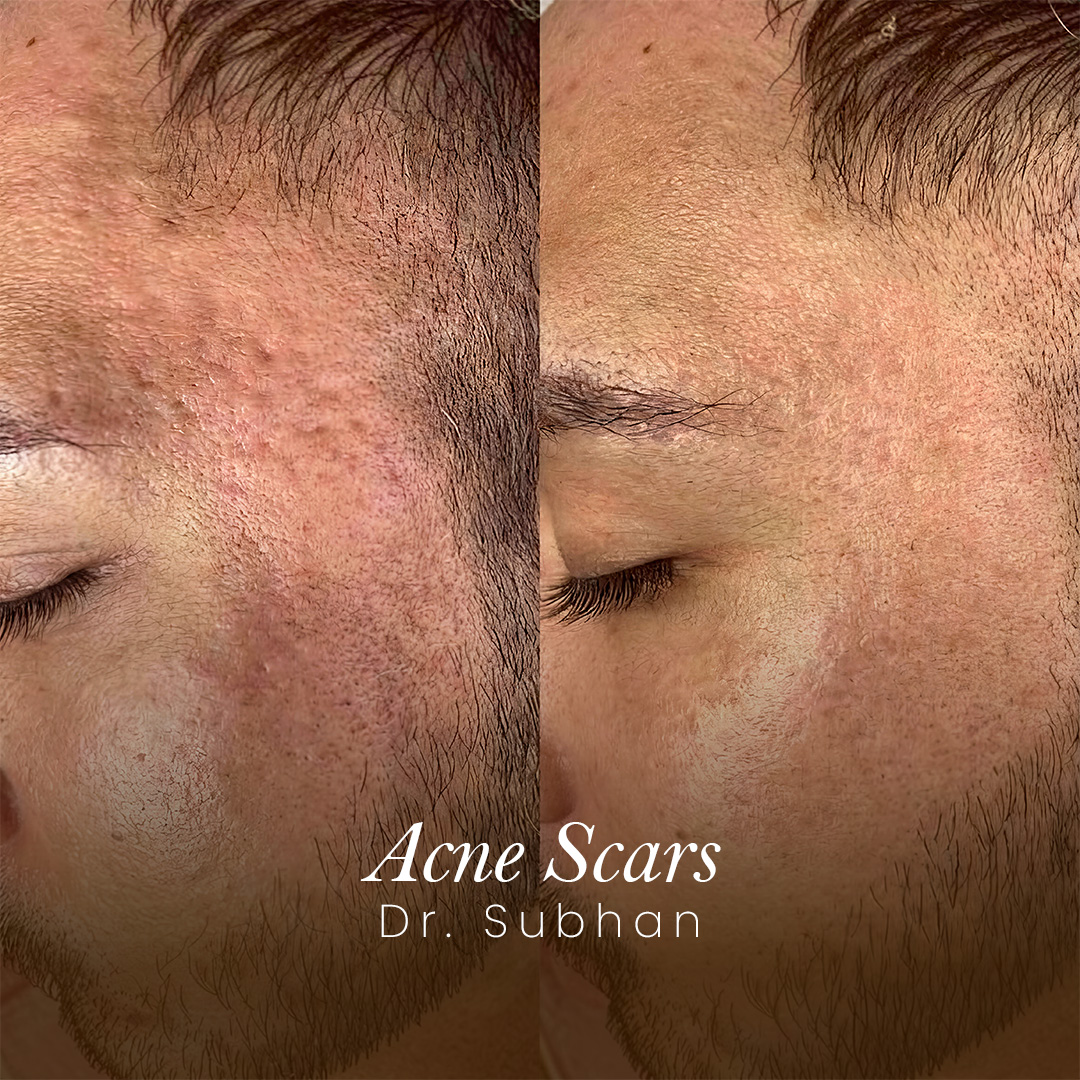 Acne Scar