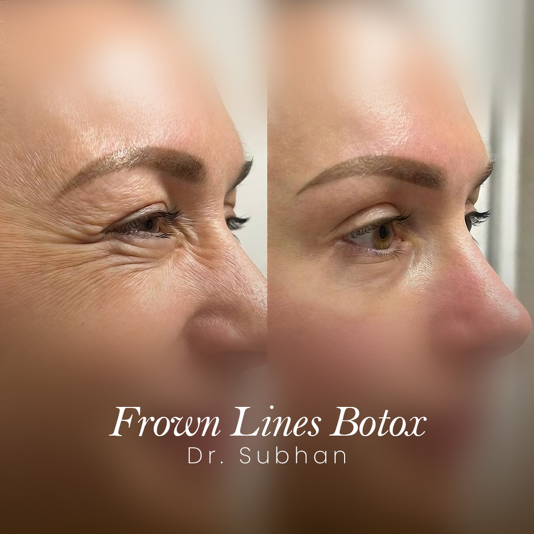 Botox