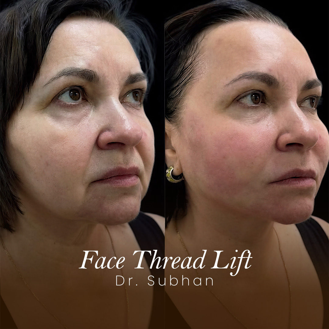 Face Thread Lift