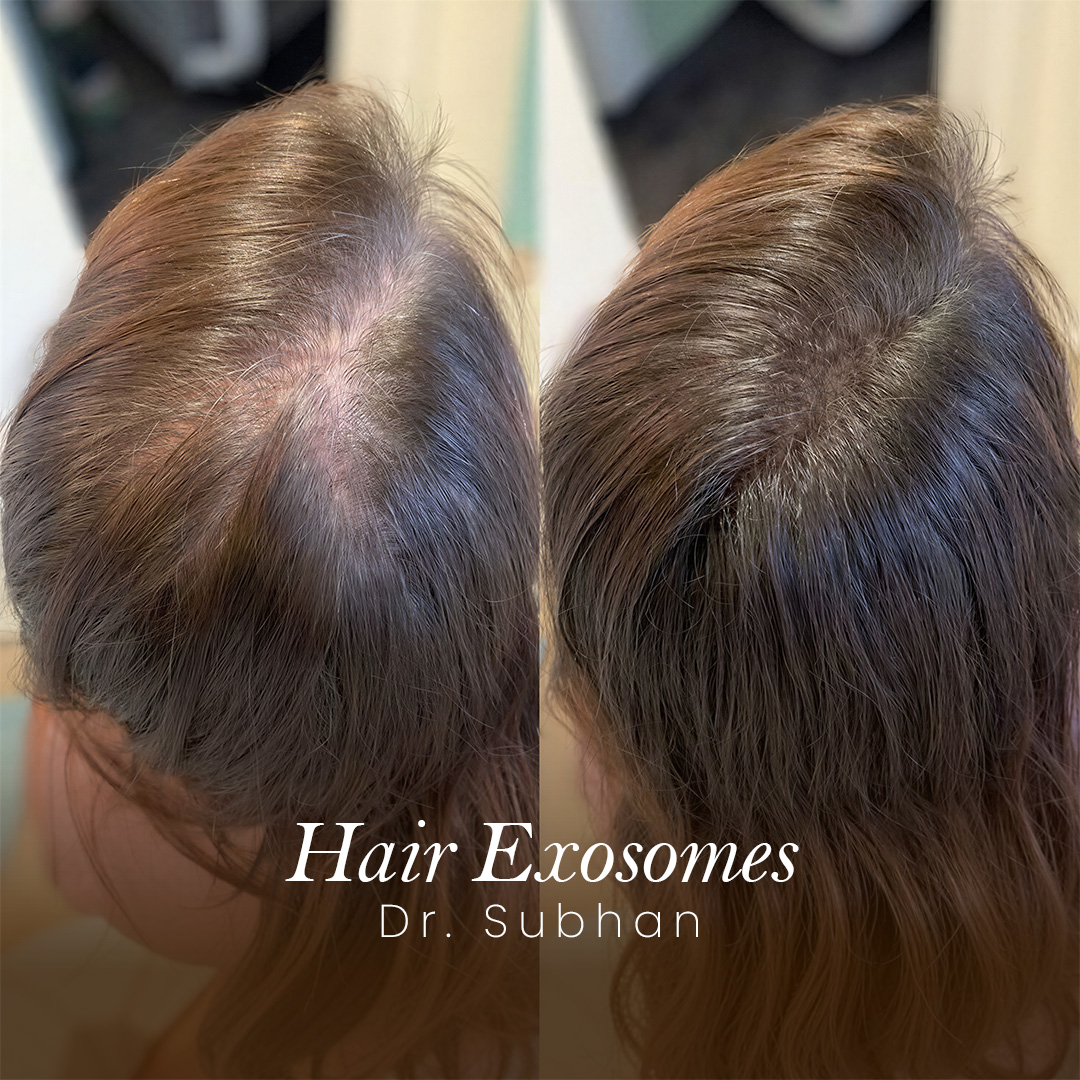 Hair Exosomes