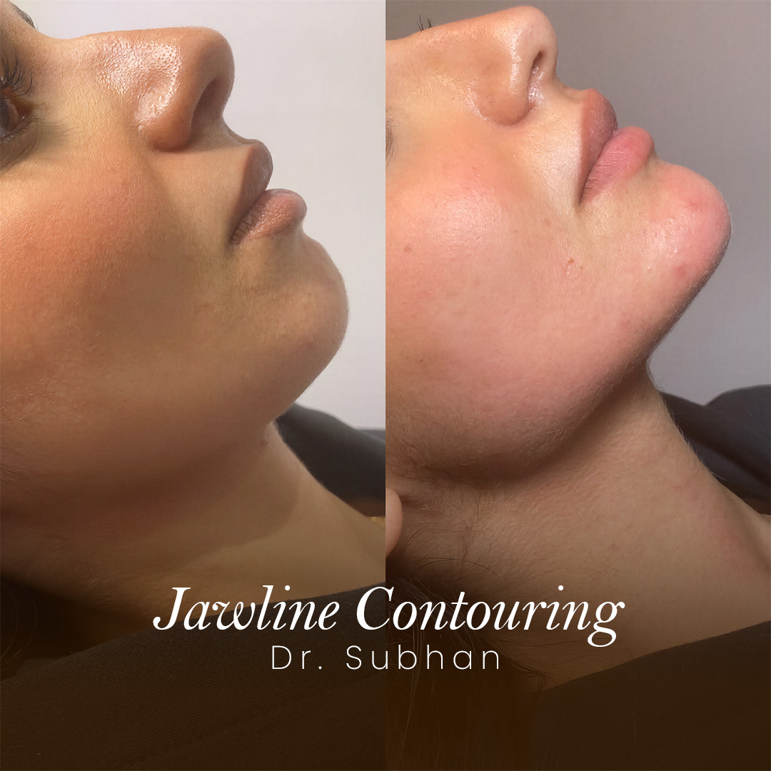 Jawline Filler