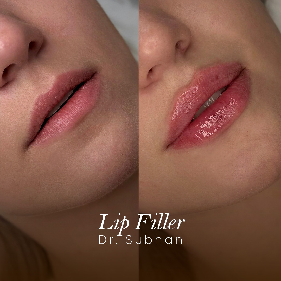 Lip Filler