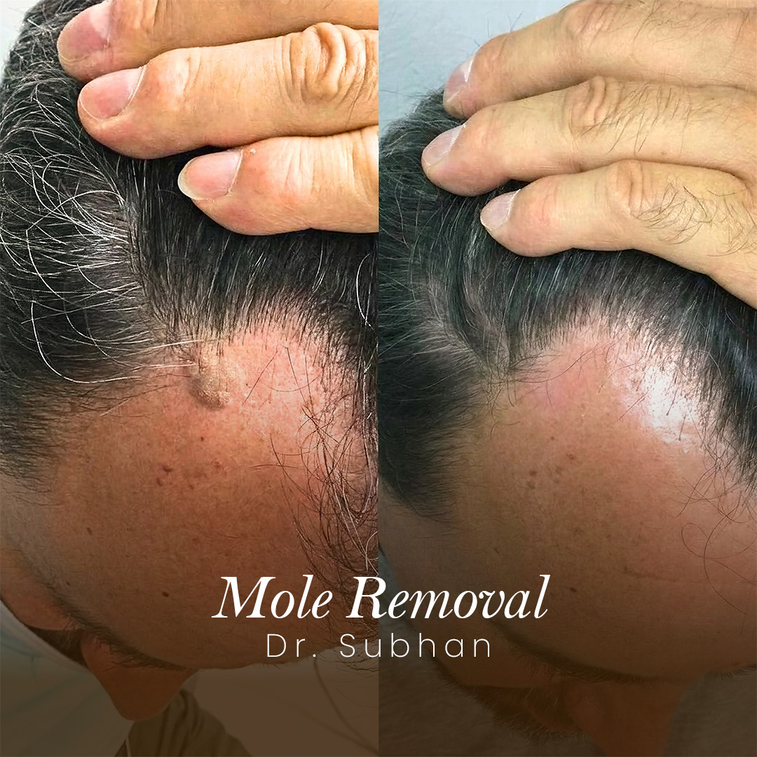 Mole Removal