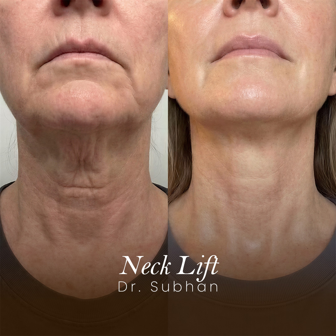 Neck Lift